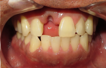 Implant Before